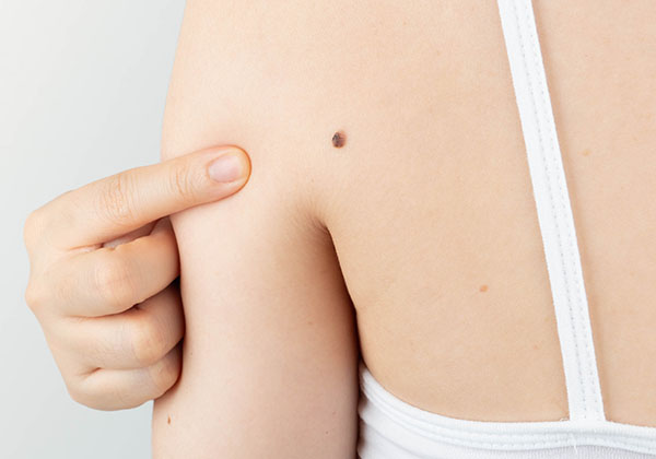 Self Exam | Oasis Dermatology