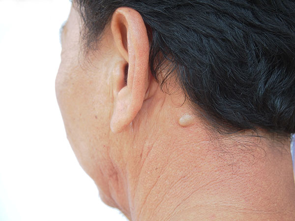 Sebaceous Cyst Treatment | Oasis Dermatology