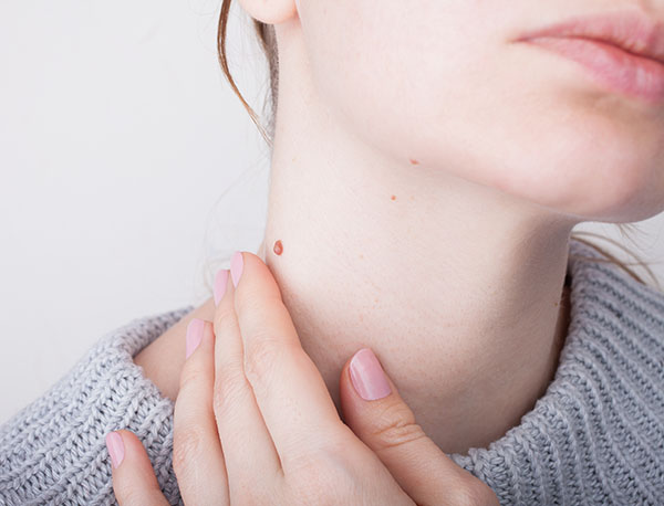 Mole Excision| Oasis Dermatology