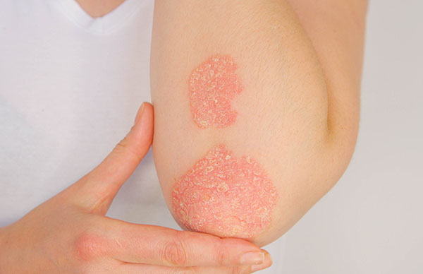Psoriasis | Oasis Dermatology
