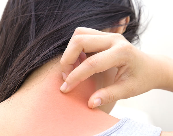 Rashes Treatment | Oasis Dermatology