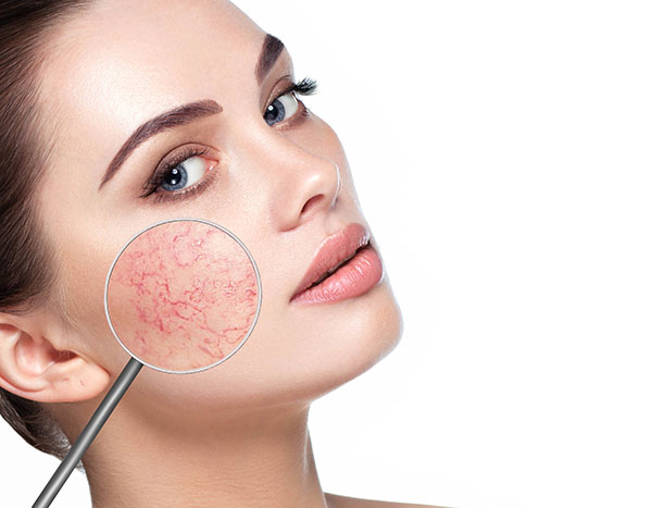 Rosacea Treatment | Oasis Dermatology