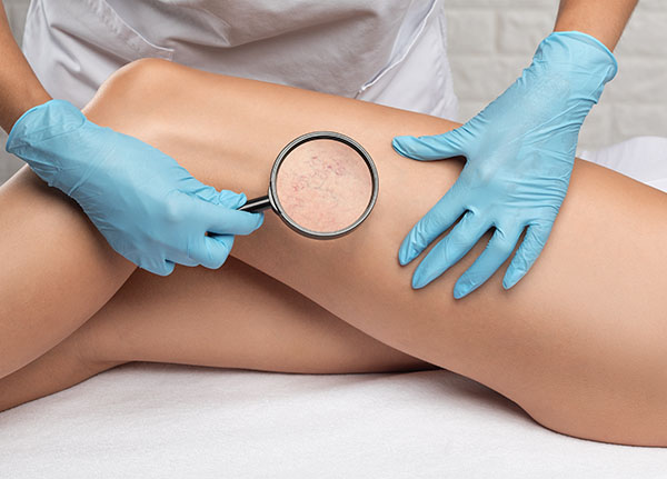 Blood Vessel Sclerotherapy | Oasis Dermatology