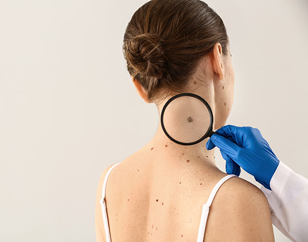 Skin Cancer Removal | Oasis Dermatology