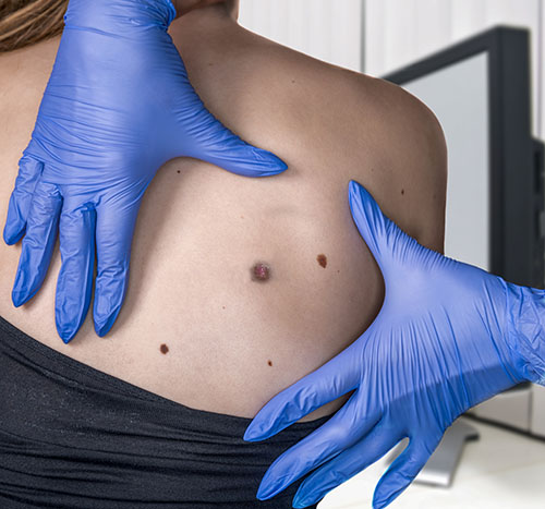 Skin Cancer Screening | Oasis Dermatology