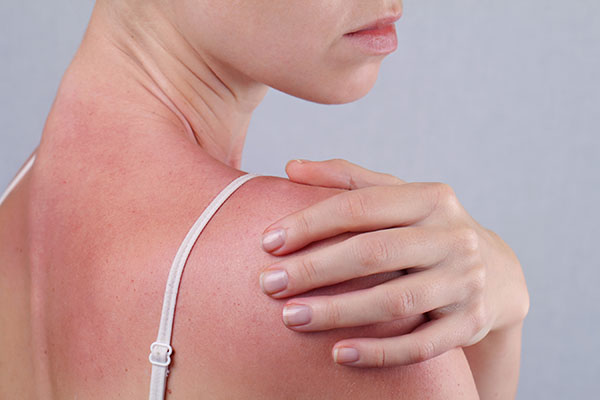 Sun Damage | Oasis Dermatology