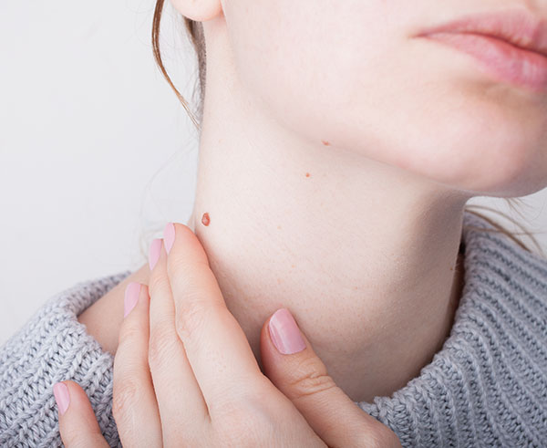Warts Removal | Oasis Dermatology