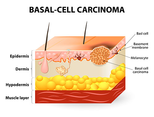 Basal Cell Carcinoma | Oasis Dermatology