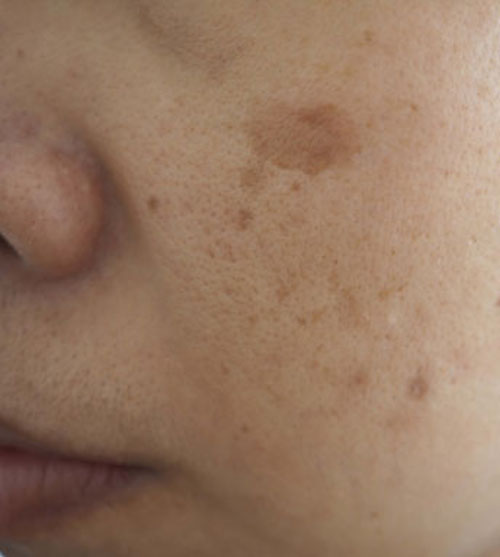 Brown Spot Treatment | Oasis Dermatology