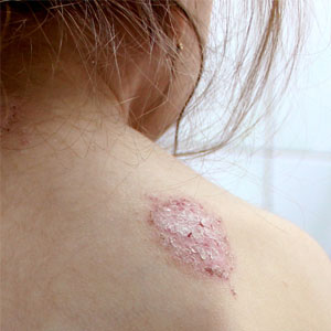 Nummular - Eczema Treatment | Oasis Dermatology