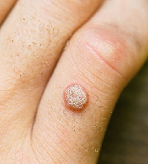 Warts Removal | Oasis Dermatology