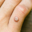 Warts Removal | Oasis Dermatology