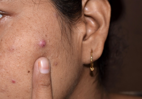 Acne Treatment | Oasis Dermatology