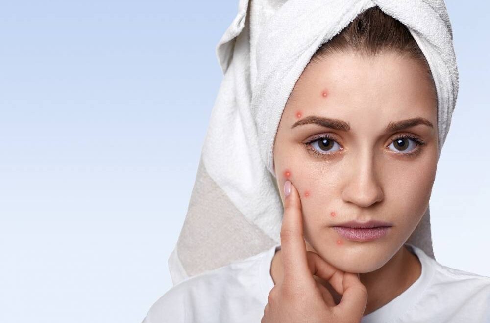 What is the Best Treatment for Teenage Acne?