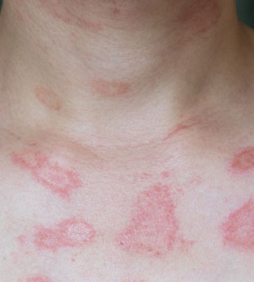 Allergy Treatment | Oasis Dermatology