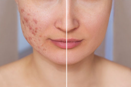 Acne Scarring