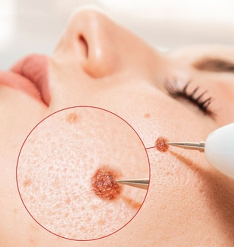 Electrocautery | Oasis Dermatology