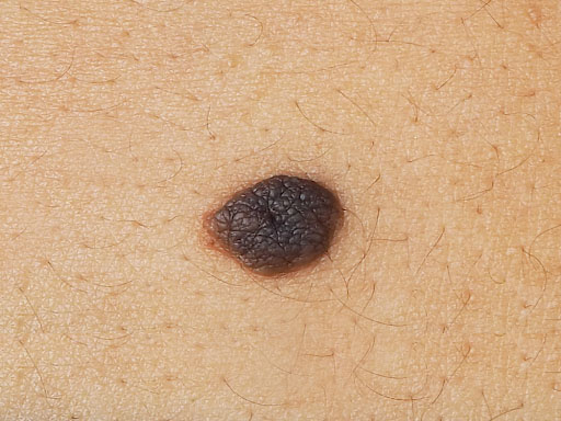 Mole, Dysplastic Nevi, And Melanoma Excisions