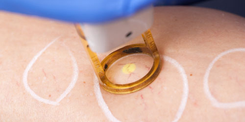 Pulse-Dye Laser Resurfacing Pulse-Dye Laser Resurfacing | Oasis Dermatology
