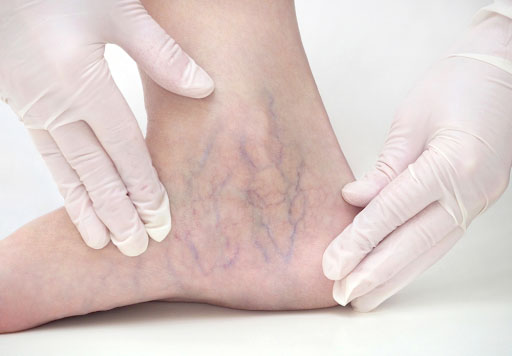 Sclerotherapy