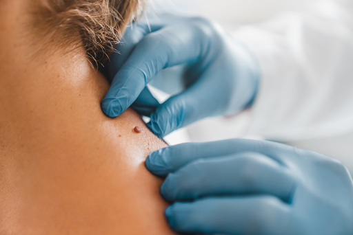 benign growth removal | Oasis Dermatology