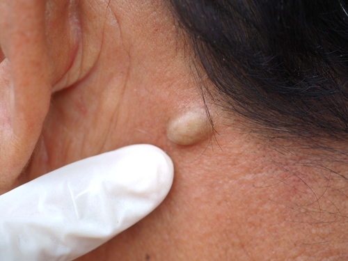 Surgical Dermatology | Oasis Dermatology