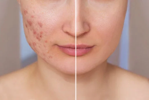 Efficient Ways to Get Rid of Acne Scars